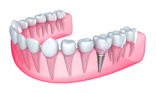 Ilustração de implante dentário